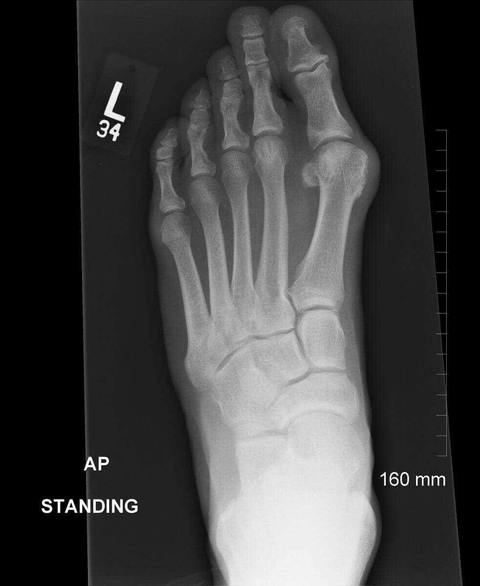 bunion x ray 3 1