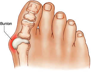 What is the best treatment for a bunion on the big toe?