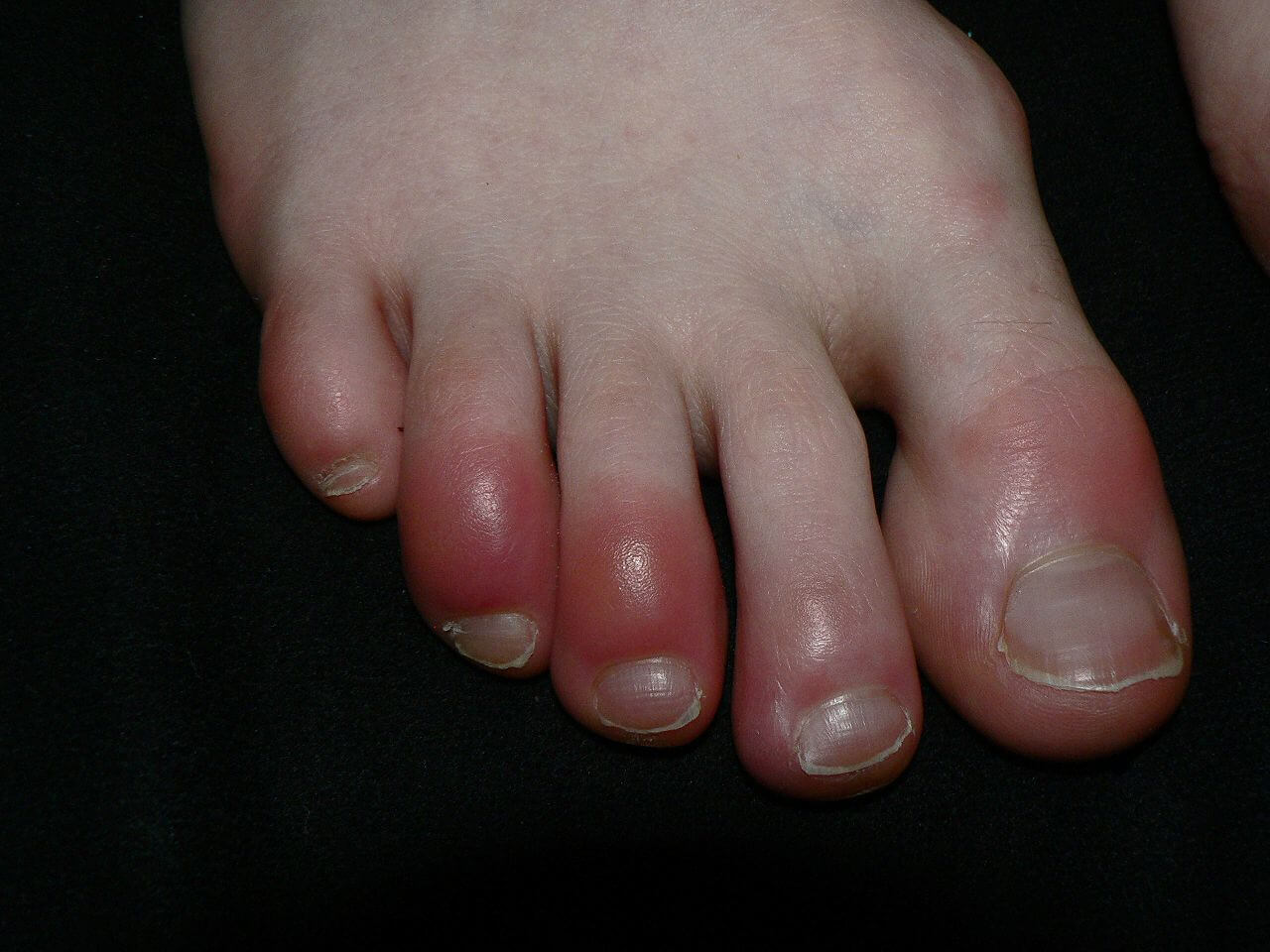 Hammertoe