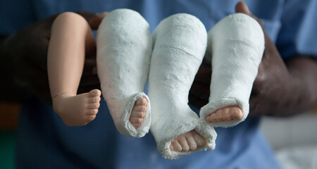 clubfoot ponseti gift