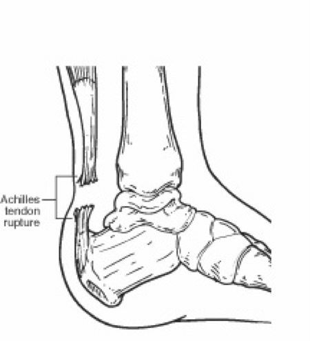 achilles tendon rupture