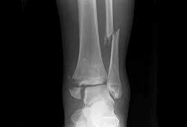 ankle fractures