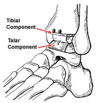 ankle replacement