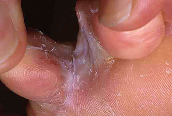 athletes foot tinea w13