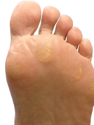 Plantar callus removal: how to get rid of calluses on feet