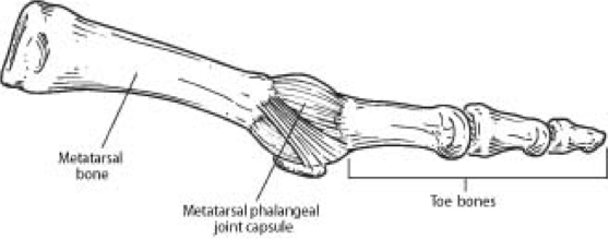 capsulitis