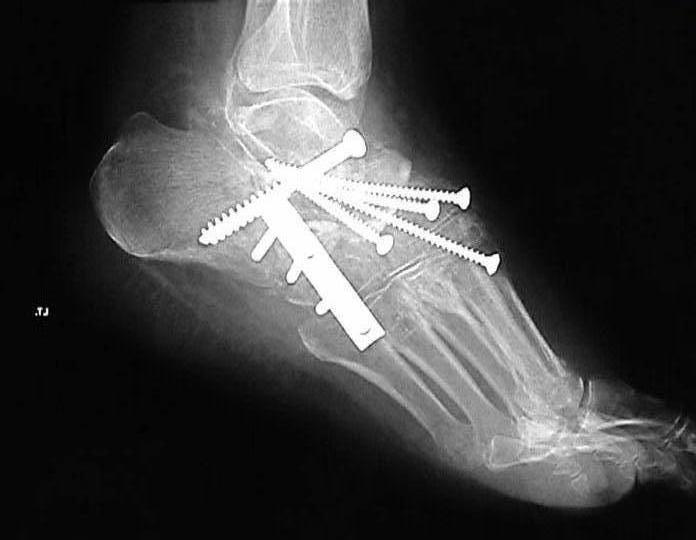 charcot joint left foot postop