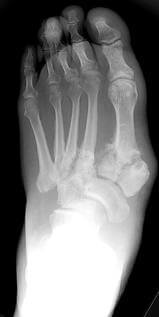 charcot xray dp