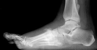 charcot xray