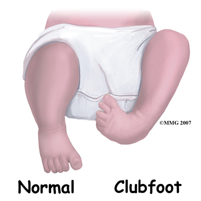 child foot clubfoot anatomy