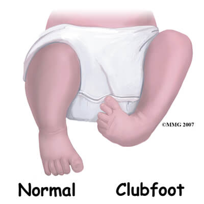 Clubfoot Treatment Foot Doctor Southlake Keller Flower Mound North Richland Hills And Argyle Tx