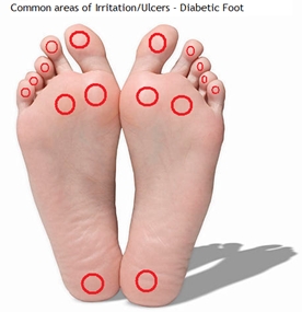 diabetic foot 1