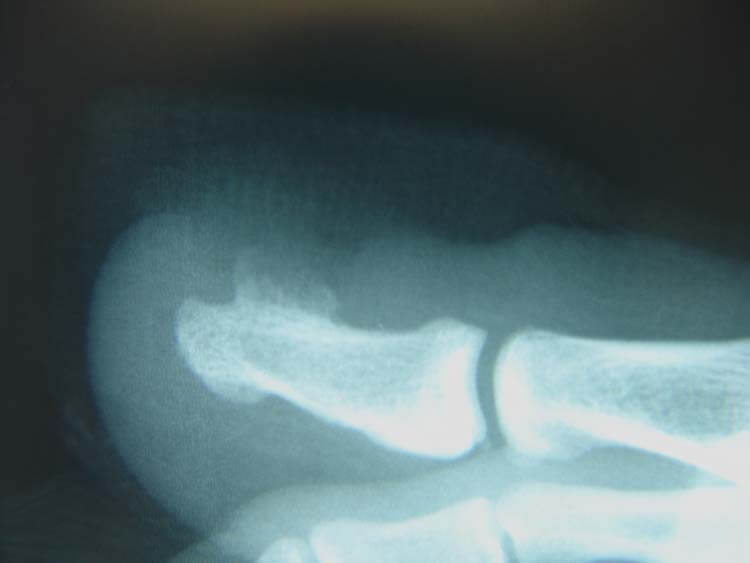 enchondroma hallux