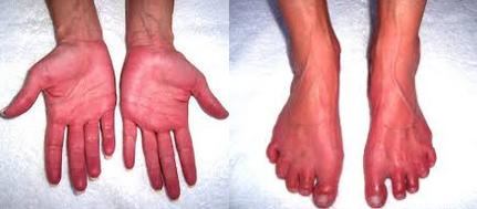 erythromelalgia