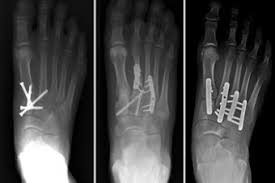 footfractures