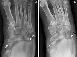 footfractures2