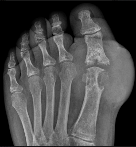 gout xray of the foot big toe joint