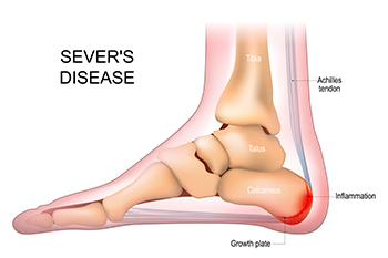 Causes and Treatment for Sever s Disease