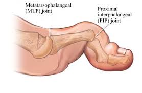 hammertoe 1