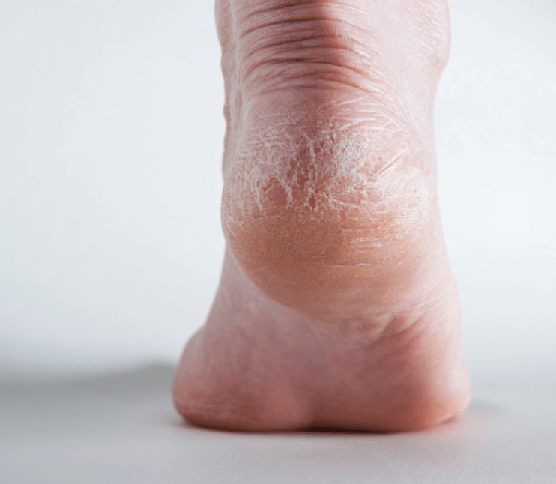 heel callus