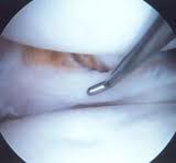 intraop pic