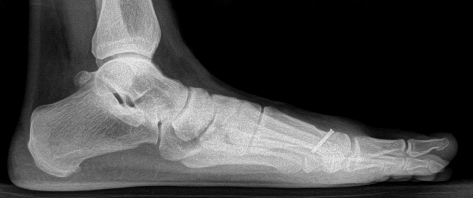lateral xray