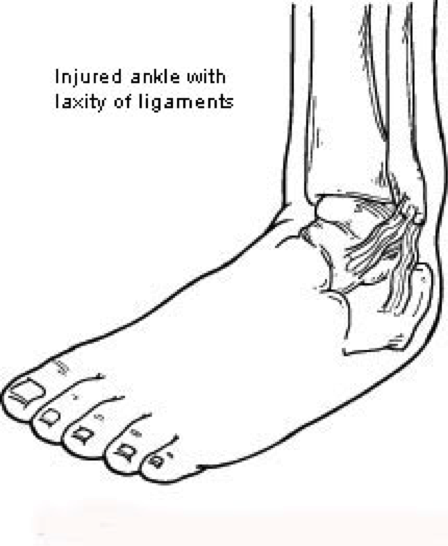 ligament laxity 1