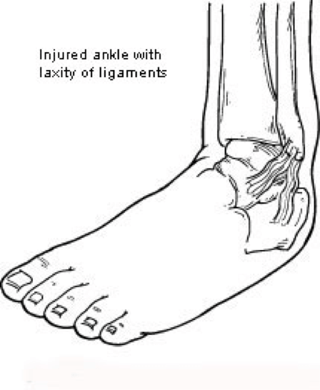 ligament laxity 1