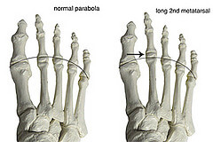 long 2nd metatarsal