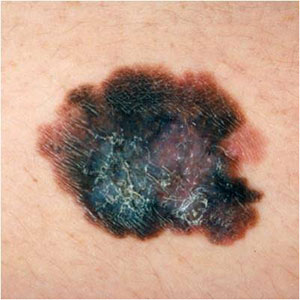 melanoma