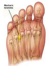 neuroma pic