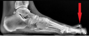 new hammertoe xray