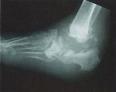 osteomyelitis 1