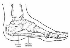 plantarfibroma