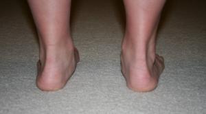 pronation of feet