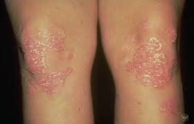 psoriasis