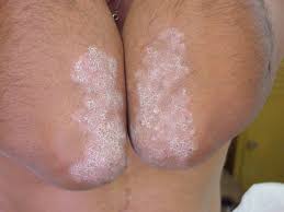 psoriasis2