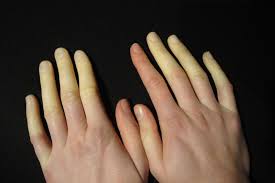 raynauds