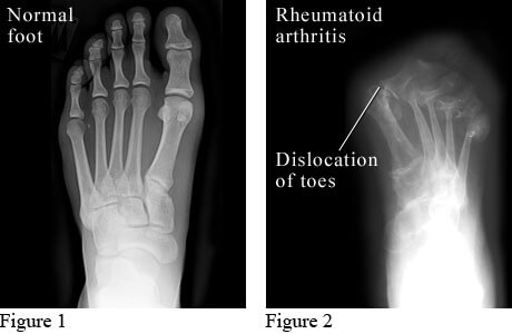 rheumatoid