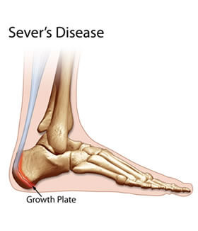 severs disease