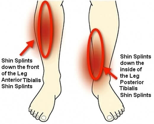 shin splints