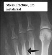 stress fracture1