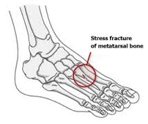 stressfractures