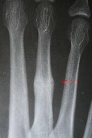 stressfractures2