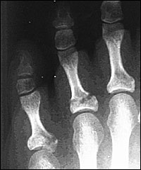 toe fractures 1