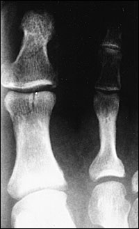 toe fractures 2