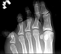 toe fractures 3