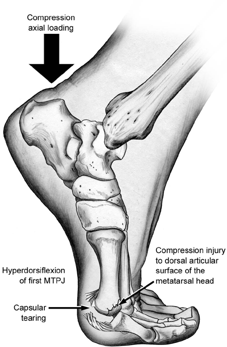 turf-toe-treatment-foot-doctor-southlake-keller-flower-mound-north