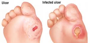 ulcers Treatment in the Southlake, Keller, Flower Mound, North Richland Hills, Argyle, Denton, TX areas