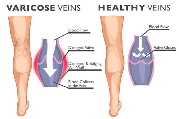 varicose veins lg